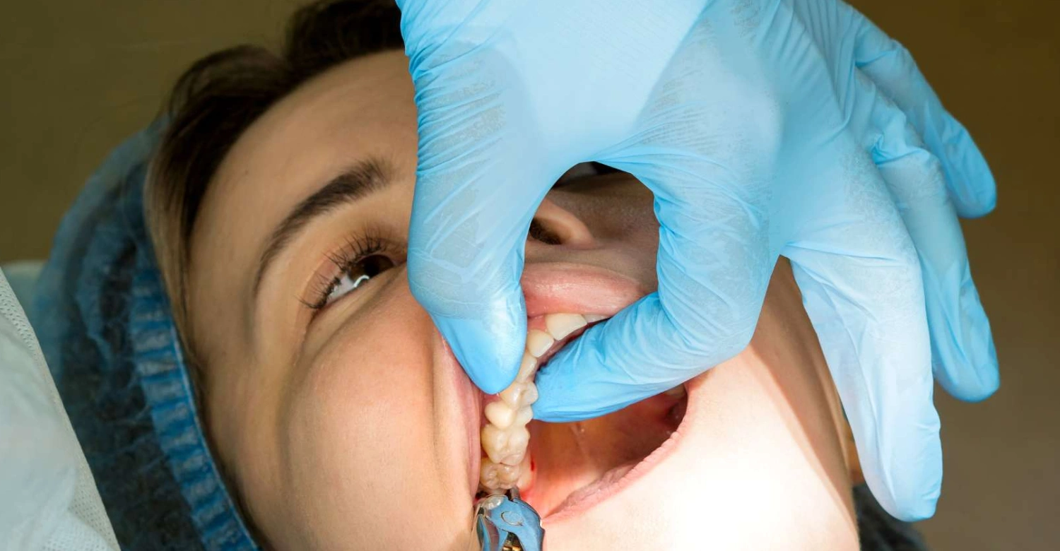 extraction des dents de sagesse In blog photo